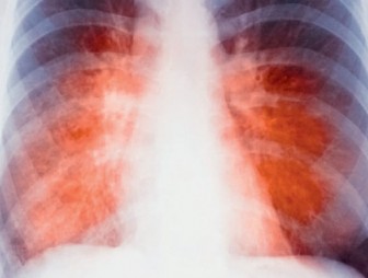 Возбудитель   туберкулёза