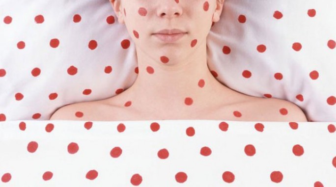 В Волковыске зарегистрировано 24 случая кори