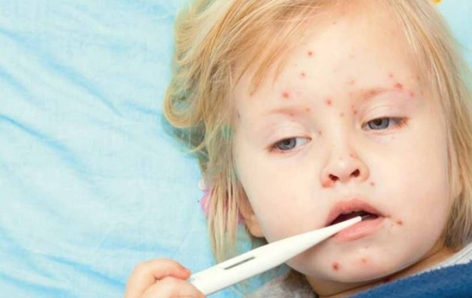 В Беларуси с февраля зарегистрирован 241 случай кори